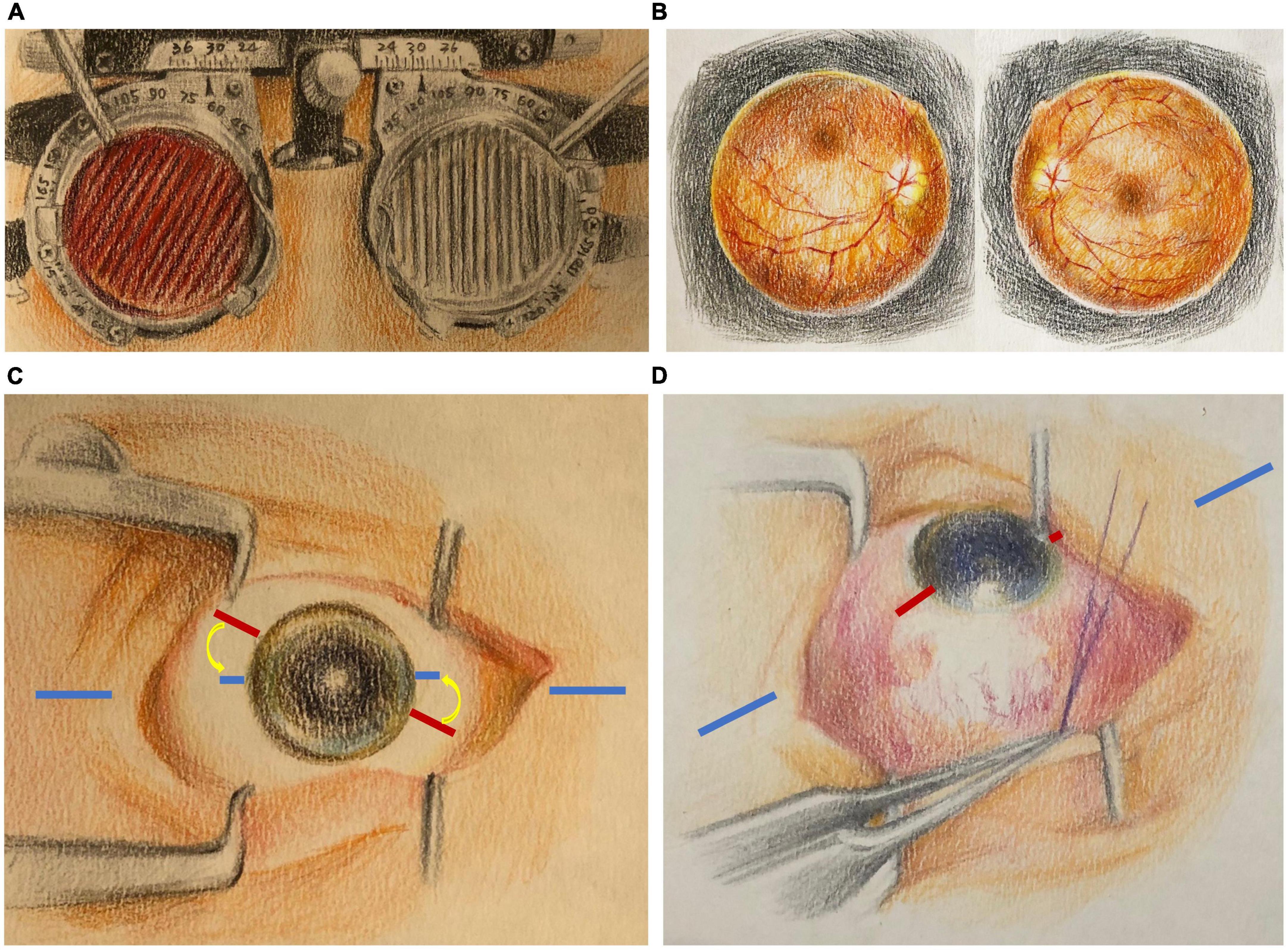 A simple marking system for accurate intraoperative monitoring and adjustment of cyclotorsion strabismus surgery
